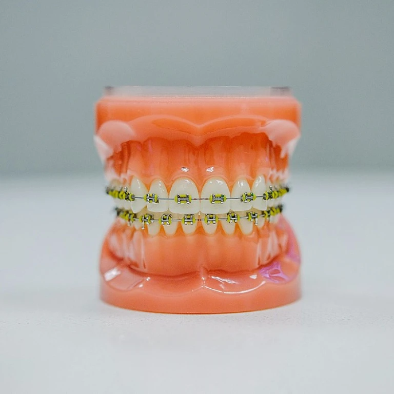 Comment la grille anti-pouce peut aider à corriger les mauvaises habitudes dentaires